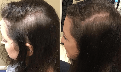 non surgical hair restoration oakville before after